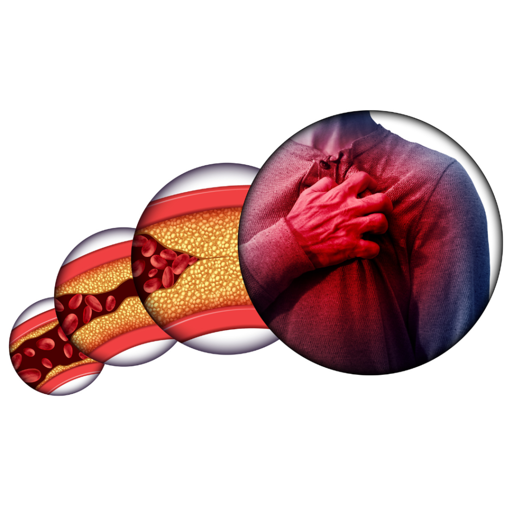 στεφανιαία αθηροσκλήρωση Coronary atherosclerosis