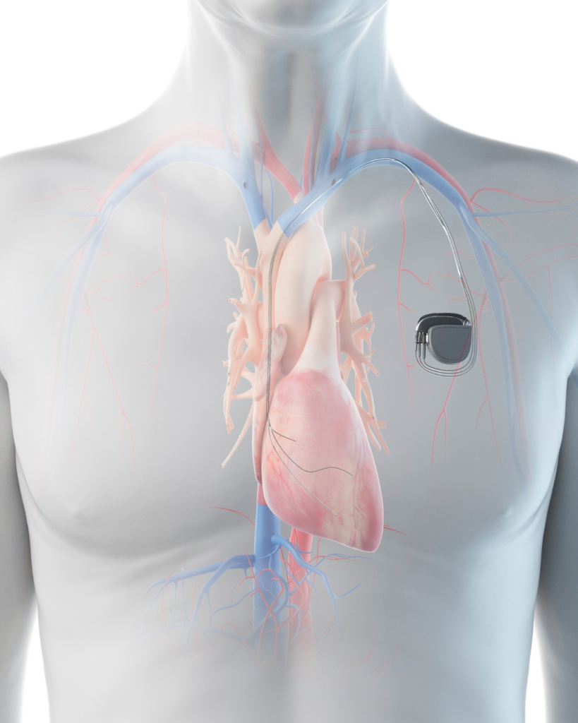 βηματοδότης heart pacemaker